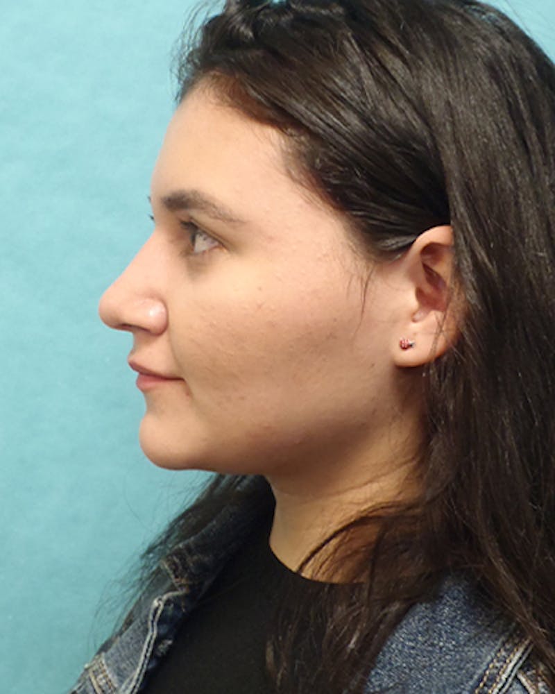 Rhinoplasty Before & After Gallery - Patient 342076 - Image 2