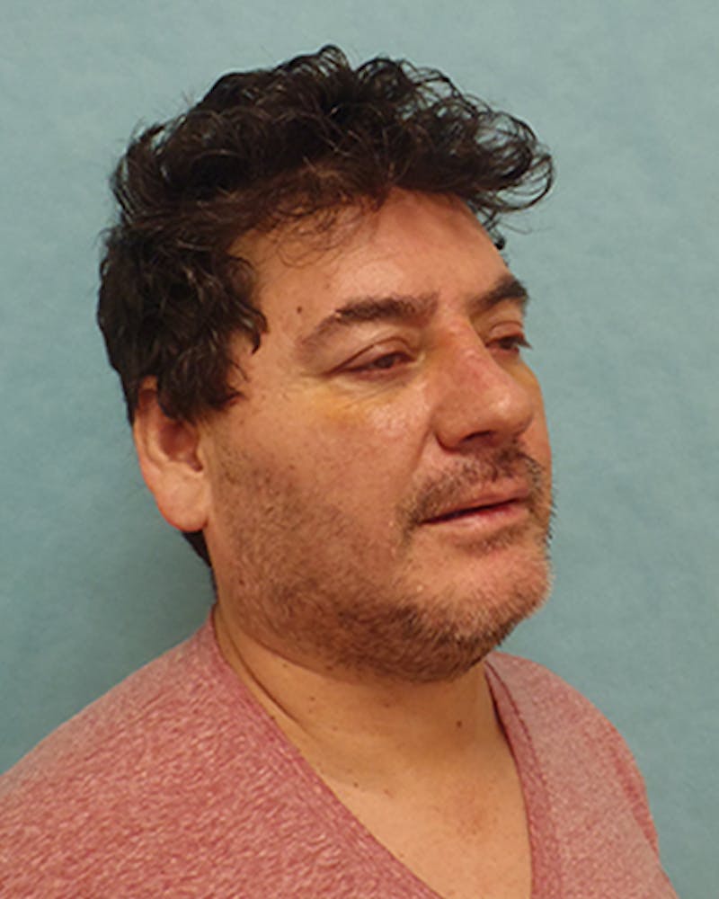 Rhinoplasty Before & After Gallery - Patient 132750 - Image 4