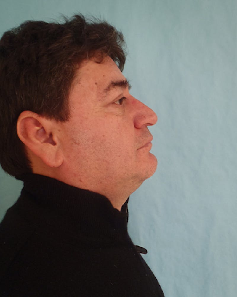 Rhinoplasty Before & After Gallery - Patient 132750 - Image 5