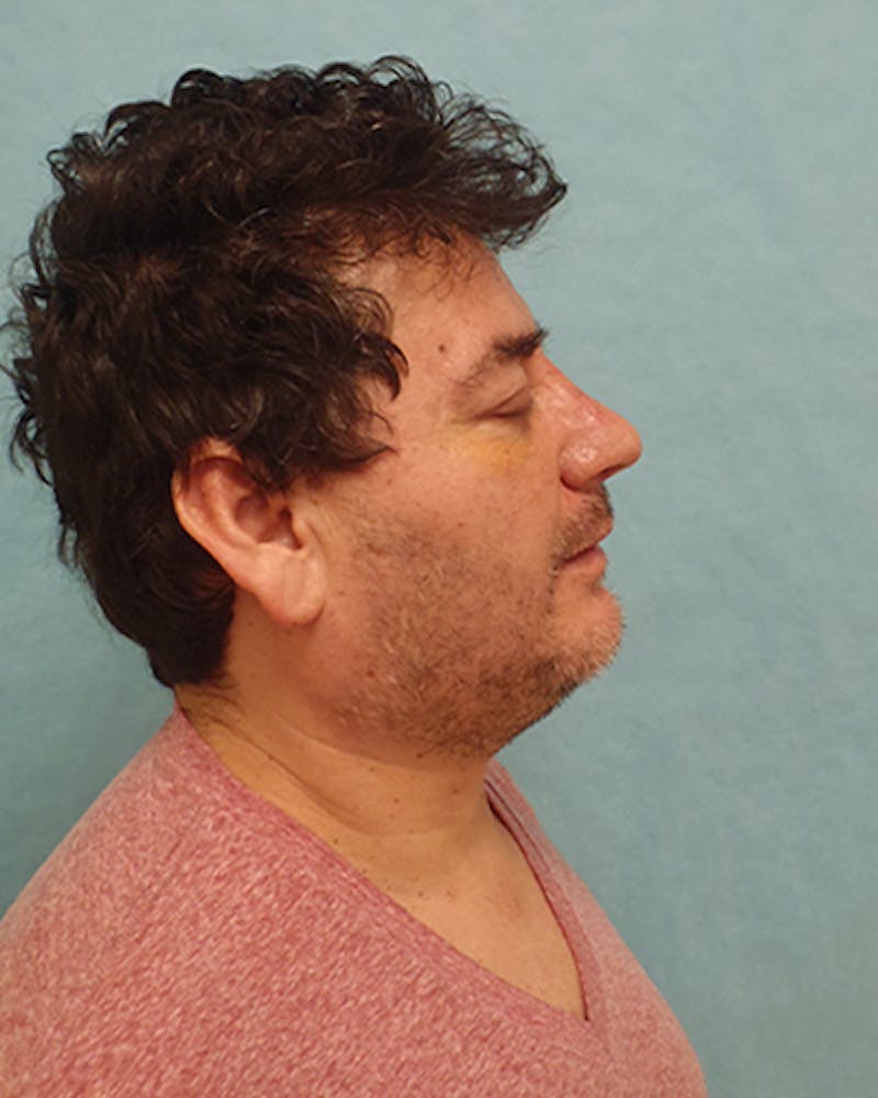 Rhinoplasty Before & After Gallery - Patient 132750 - Image 6