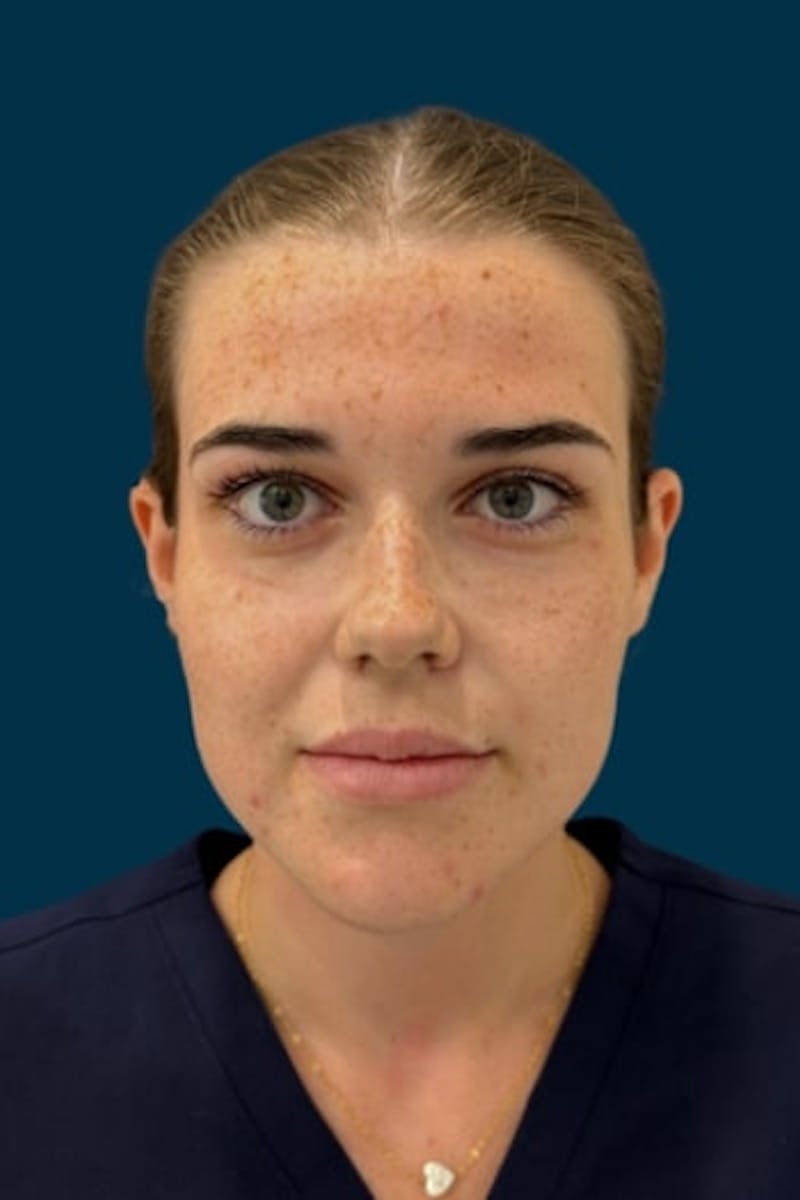 CoolPeel Before & After Gallery - Patient 253606 - Image 1