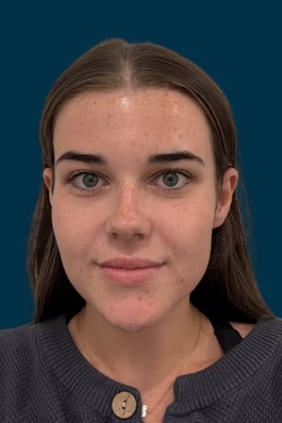 CoolPeel Before & After Gallery - Patient 253606 - Image 2