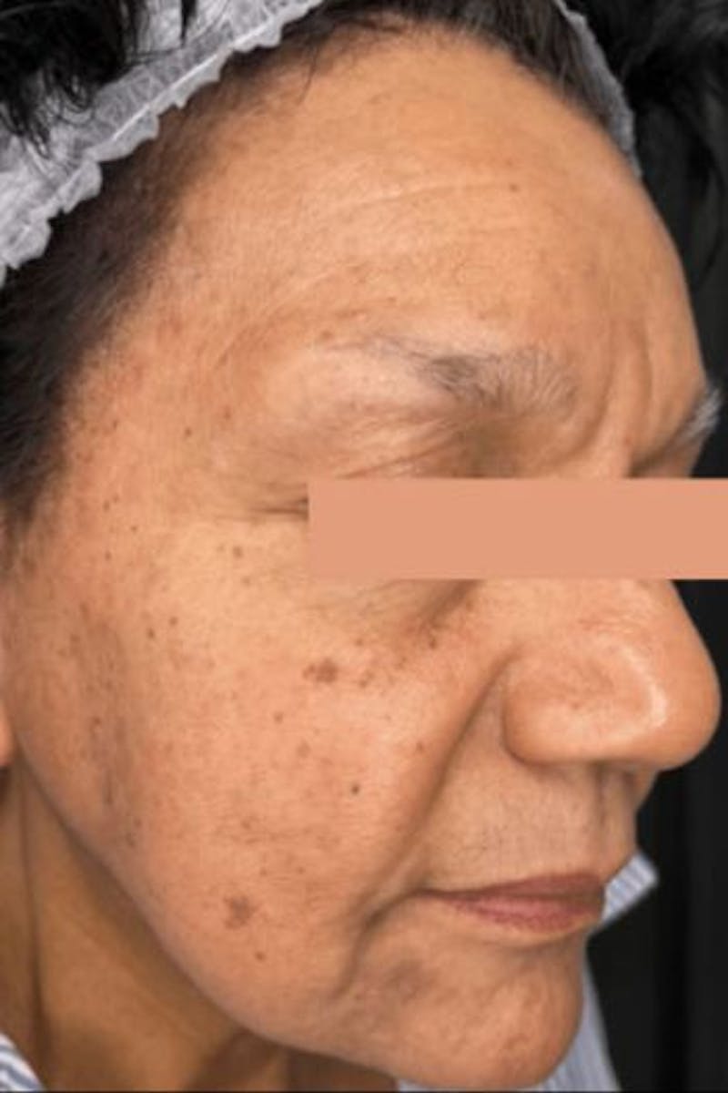 CoolPeel Before & After Gallery - Patient 248807 - Image 1