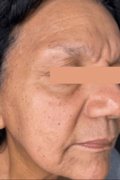 CoolPeel Before & After Gallery - Patient 248807 - Image 2