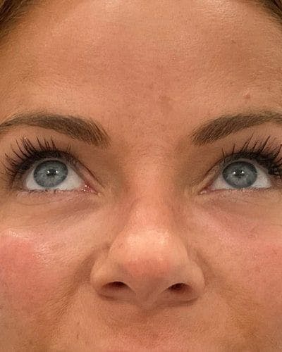 PRF EZ Gel Before & After Gallery - Patient 129078 - Image 2