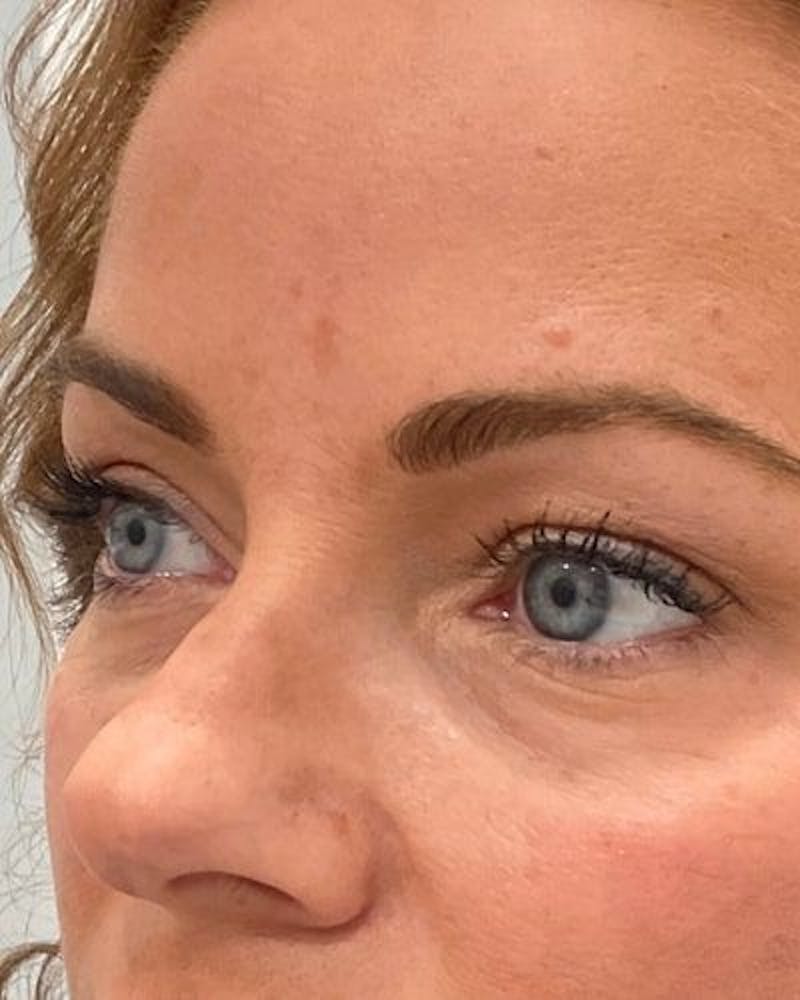 PRF EZ Gel Before & After Gallery - Patient 129078 - Image 3