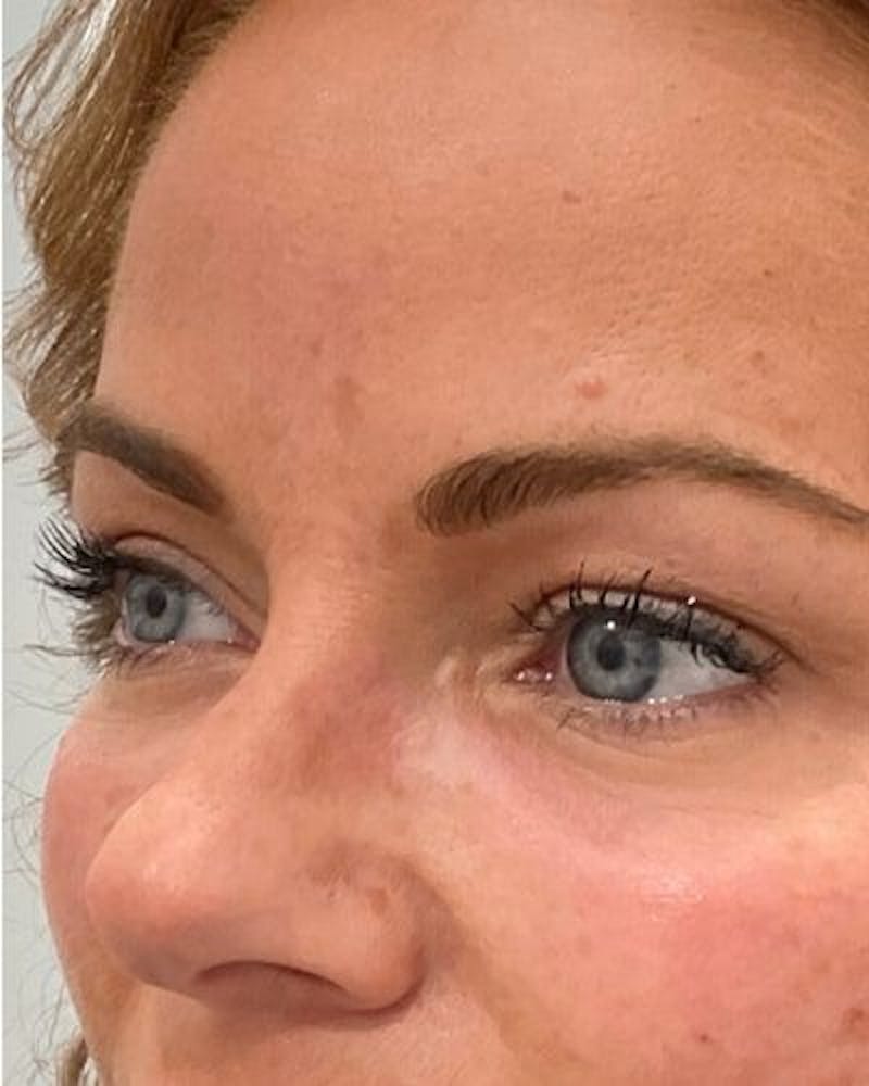 PRF EZ Gel Before & After Gallery - Patient 129078 - Image 4