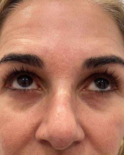 PRF EZ Gel Before & After Gallery - Patient 295219 - Image 1