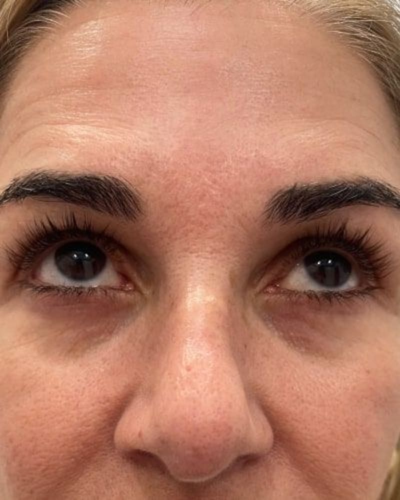 PRF EZ Gel Before & After Gallery - Patient 295219 - Image 1