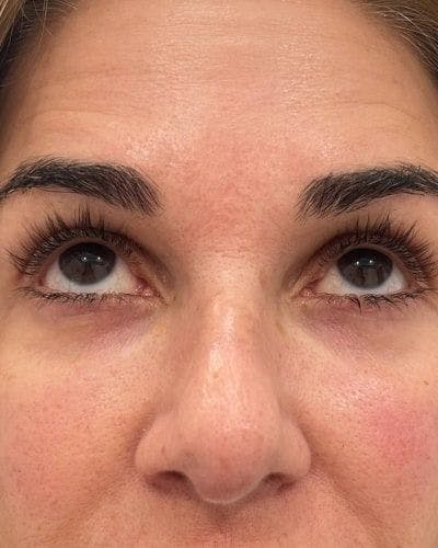 PRF EZ Gel Before & After Gallery - Patient 295219 - Image 2