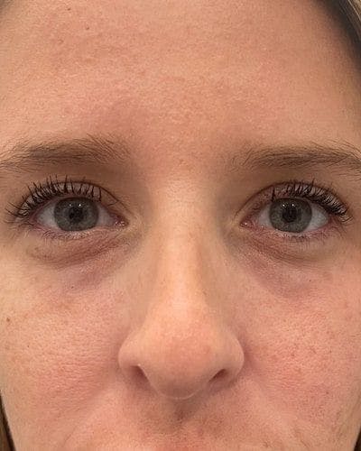 PRF EZ Gel Before & After Gallery - Patient 311019 - Image 1