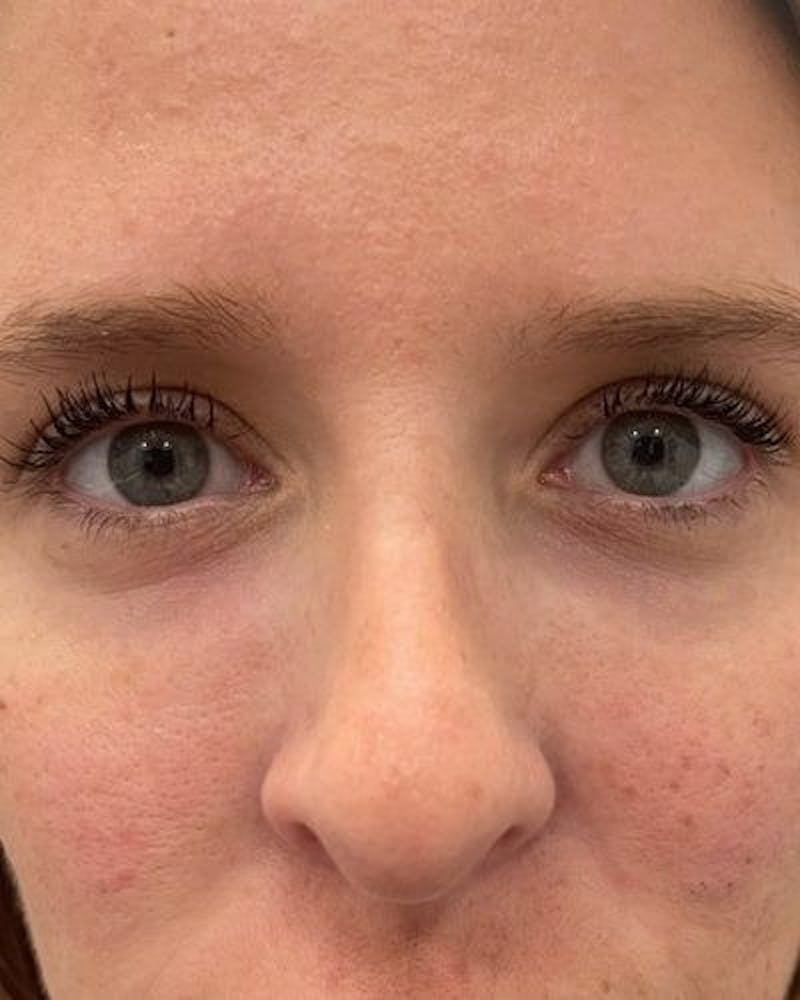 PRF EZ Gel Before & After Gallery - Patient 311019 - Image 2