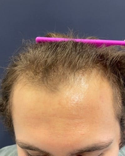 Exosomes for Hair Restoration Before & After Gallery - Patient 348796 - Image 1