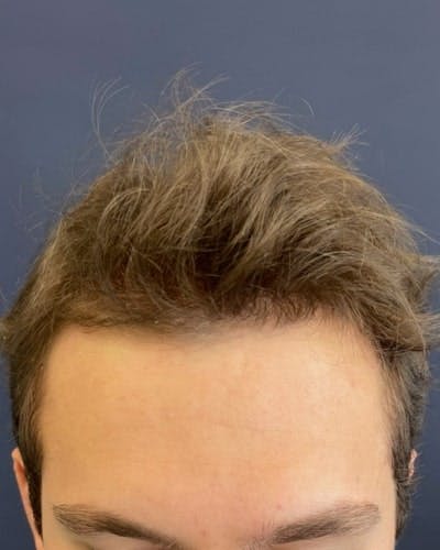 Exosomes for Hair Restoration Before & After Gallery - Patient 348796 - Image 2