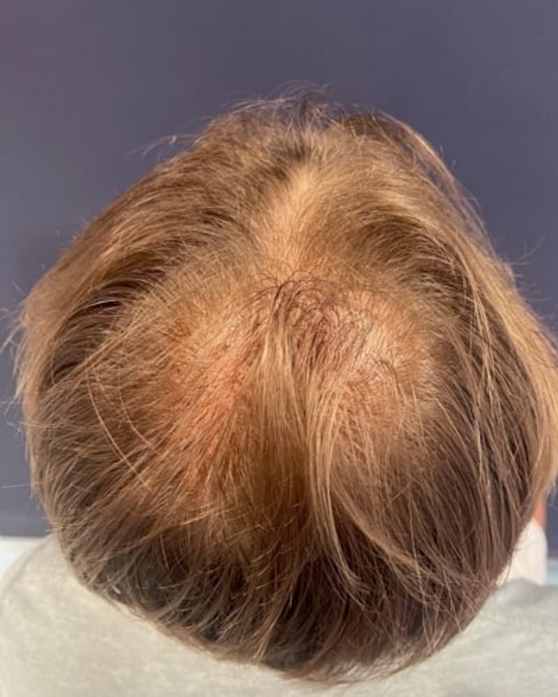 Exosomes for Hair Restoration Before & After Gallery - Patient 348796 - Image 3