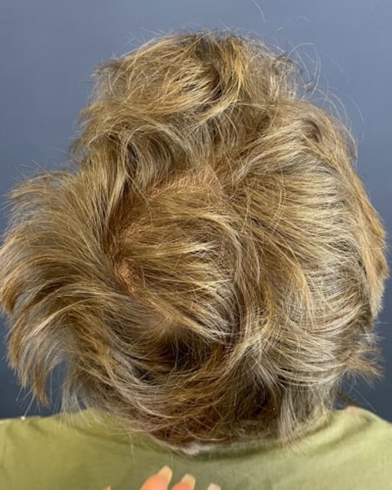 Exosomes for Hair Restoration Before & After Gallery - Patient 348796 - Image 4