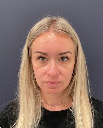Dermal Fillers Before & After Gallery - Patient 201204 - Image 1