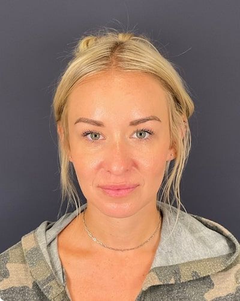 Dermal Fillers Before & After Gallery - Patient 201204 - Image 2