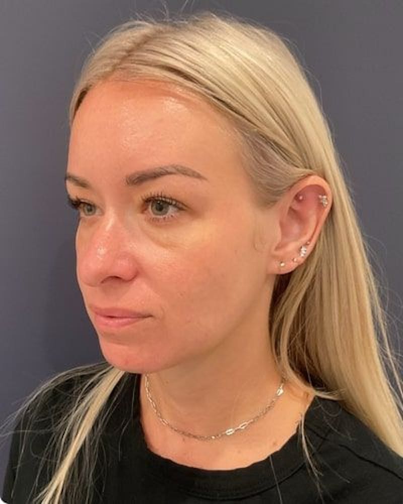 Dermal Fillers Before & After Gallery - Patient 201204 - Image 3