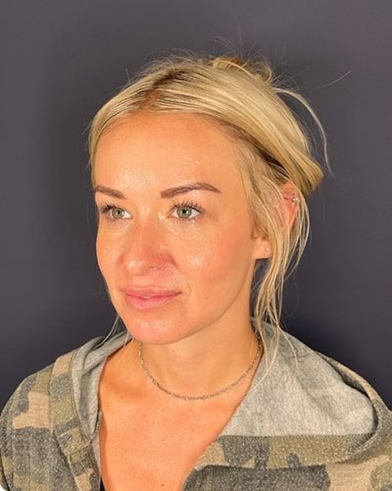 Dermal Fillers Before & After Gallery - Patient 201204 - Image 4