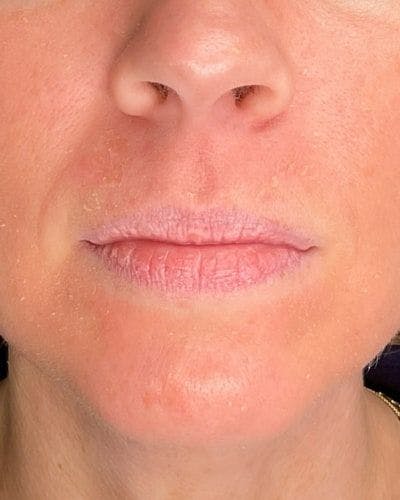 Dermal Fillers Before & After Gallery - Patient 186294 - Image 1
