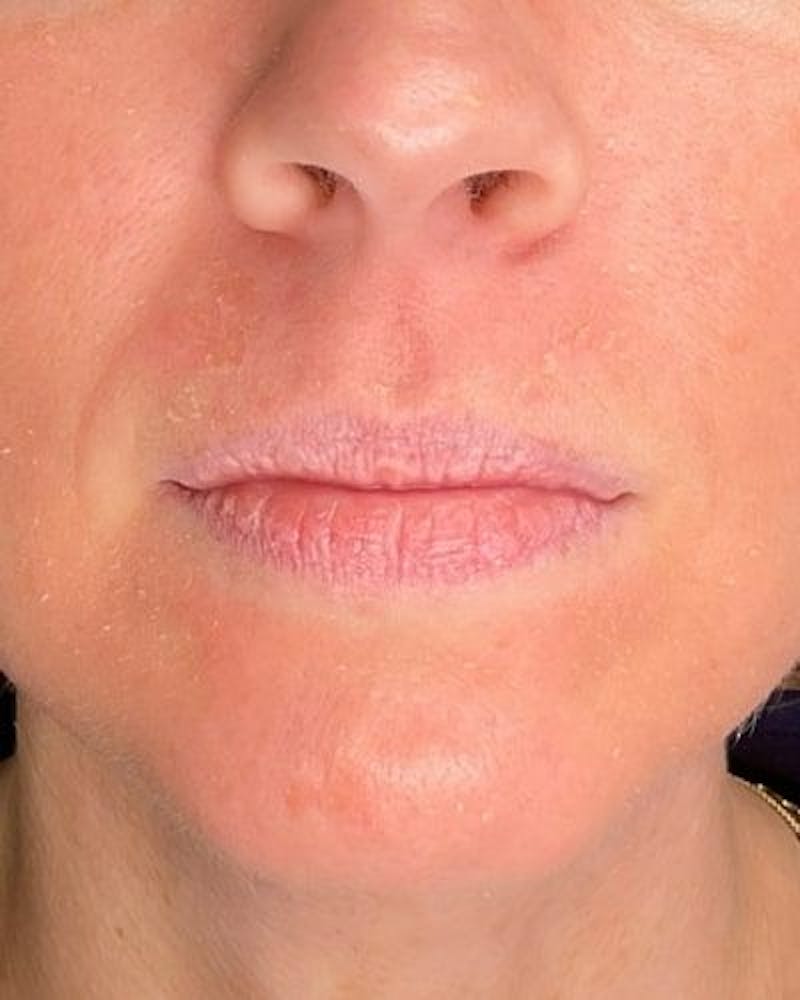 Dermal Fillers Before & After Gallery - Patient 186294 - Image 1