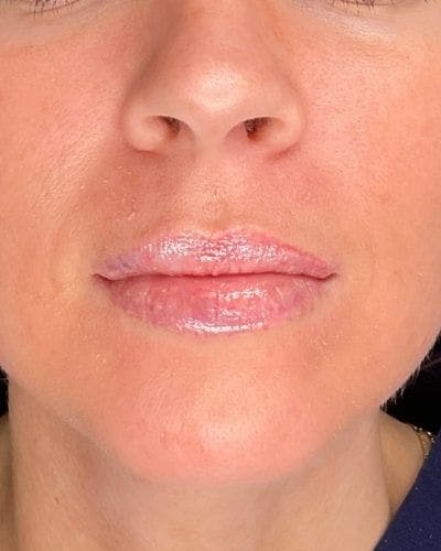 Dermal Fillers Before & After Gallery - Patient 186294 - Image 2