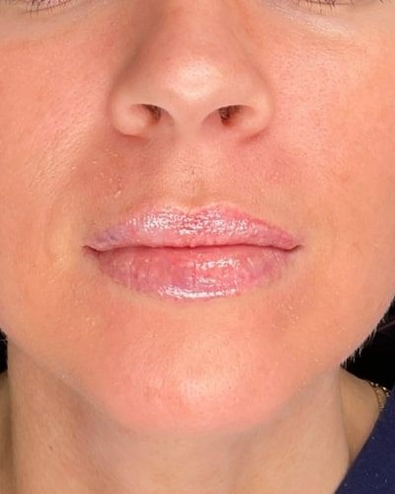 Dermal Fillers Before & After Gallery - Patient 186294 - Image 2