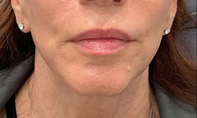 Dermal Fillers Before & After Gallery - Patient 162076 - Image 1