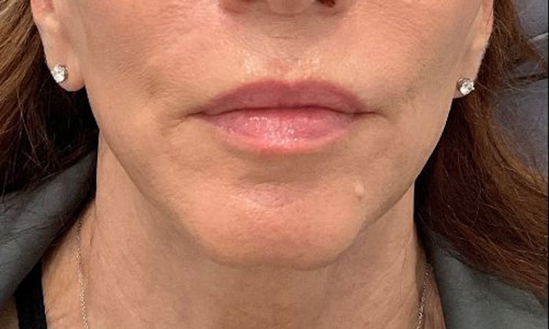Dermal Fillers Before & After Gallery - Patient 162076 - Image 1