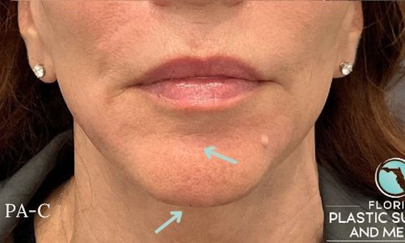 Dermal Fillers Before & After Gallery - Patient 162076 - Image 2