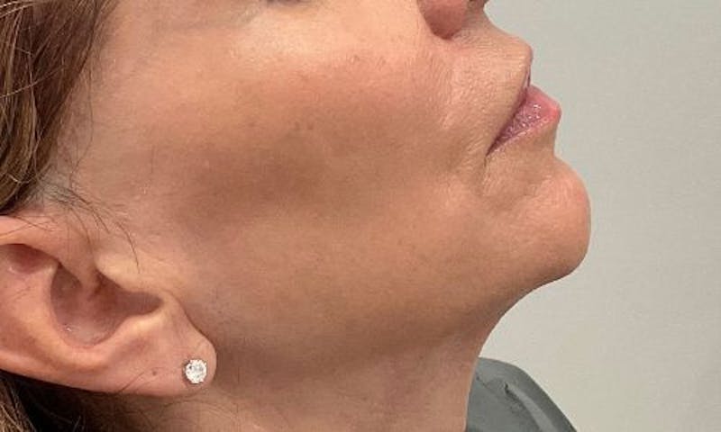 Dermal Fillers Before & After Gallery - Patient 162076 - Image 3