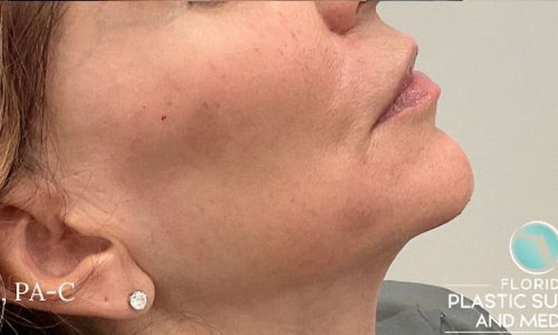 Dermal Fillers Before & After Gallery - Patient 162076 - Image 4
