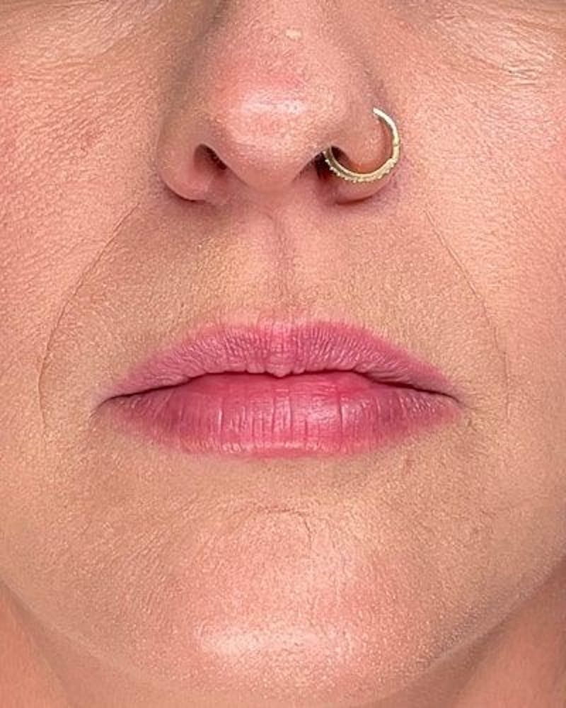 Dermal Fillers Before & After Gallery - Patient 235218 - Image 1