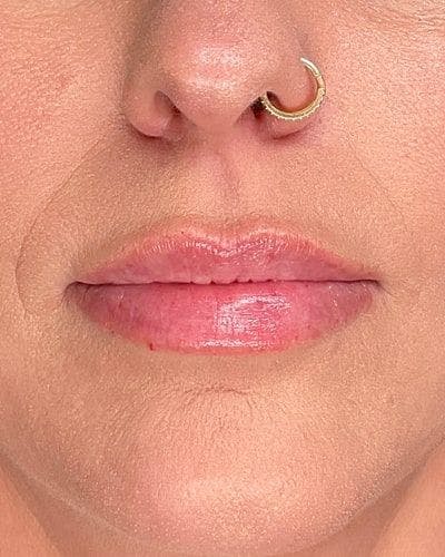 Dermal Fillers Before & After Gallery - Patient 235218 - Image 2
