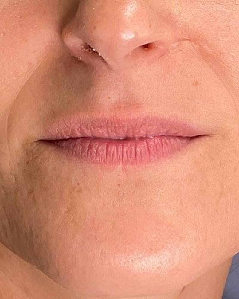 Dermal Fillers Before & After Gallery - Patient 117713 - Image 1