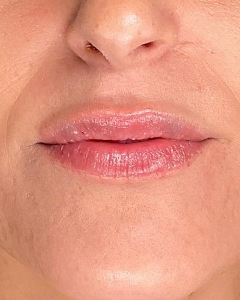 Dermal Fillers Before & After Gallery - Patient 117713 - Image 2