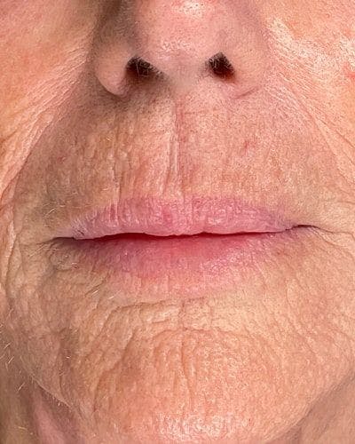 Dermal Fillers Before & After Gallery - Patient 825946 - Image 1