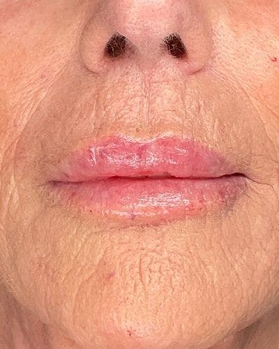 Dermal Fillers Before & After Gallery - Patient 825946 - Image 2
