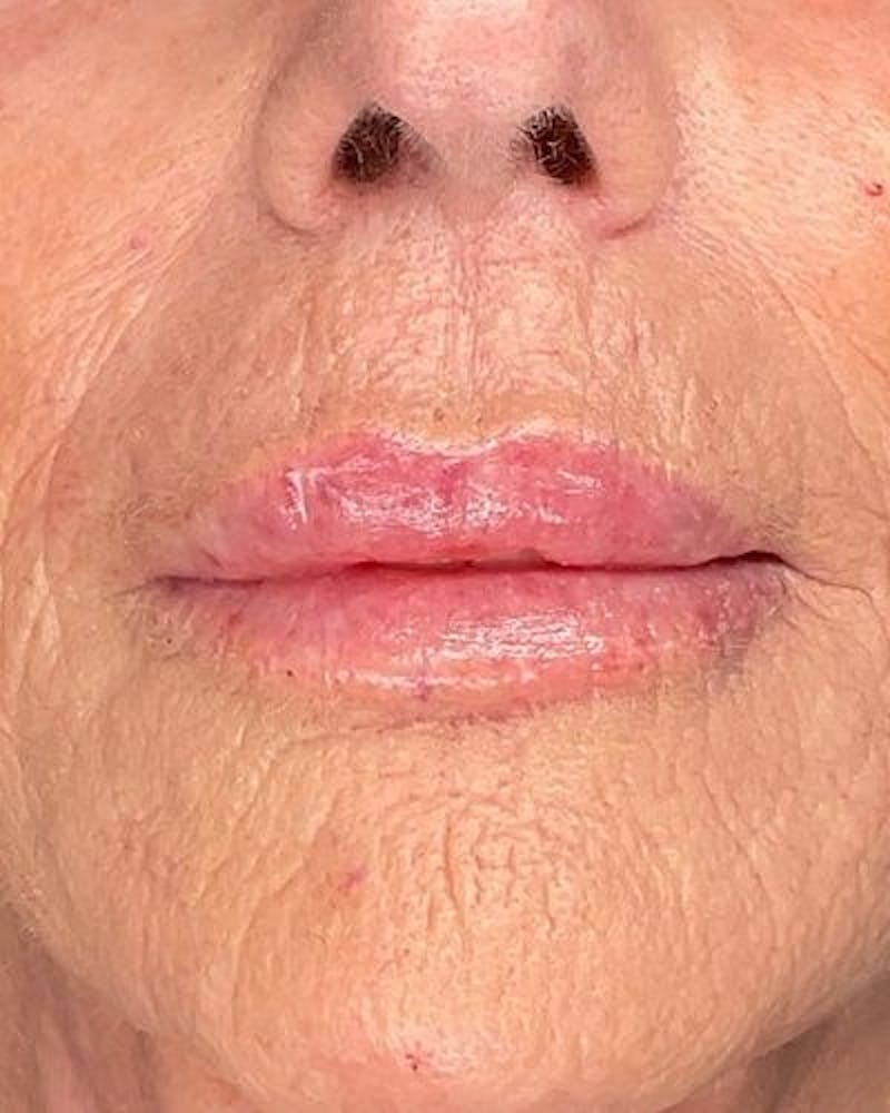 Dermal Fillers Before & After Gallery - Patient 825946 - Image 2