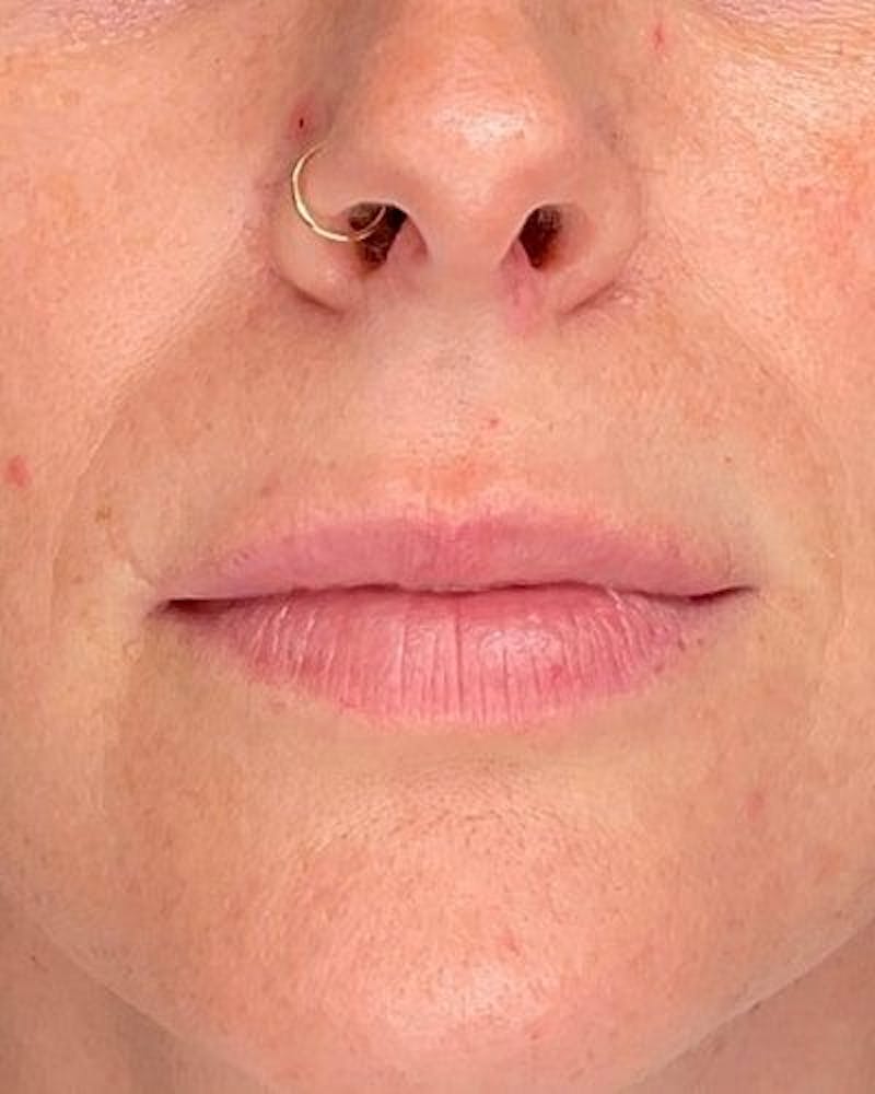 Dermal Fillers Before & After Gallery - Patient 340664 - Image 1