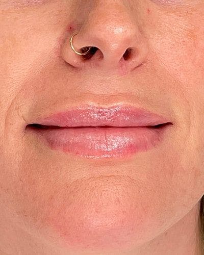 Dermal Fillers Before & After Gallery - Patient 340664 - Image 2