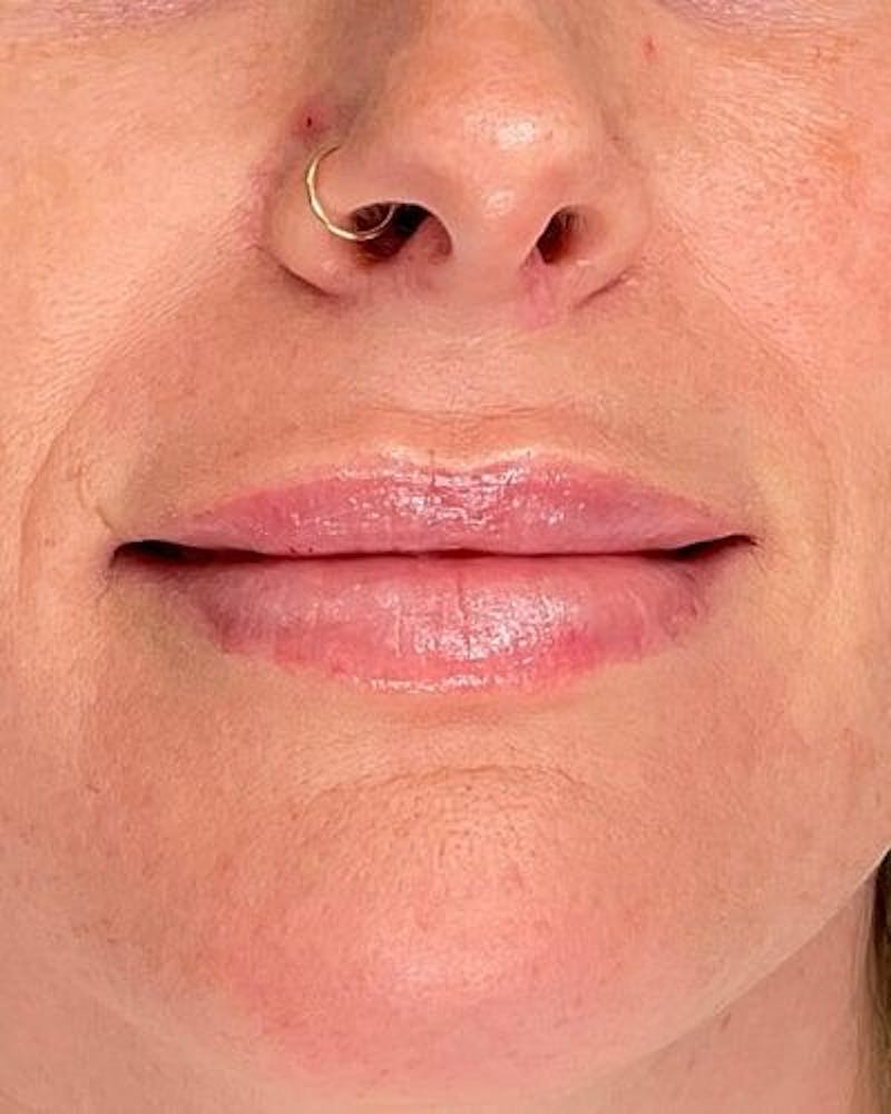 Dermal Fillers Before & After Gallery - Patient 340664 - Image 2