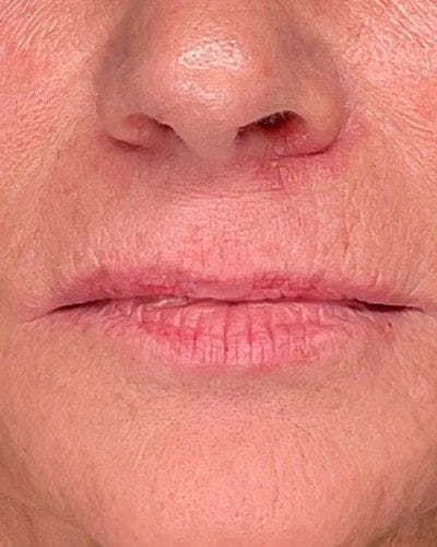 Dermal Fillers Before & After Gallery - Patient 365844 - Image 1