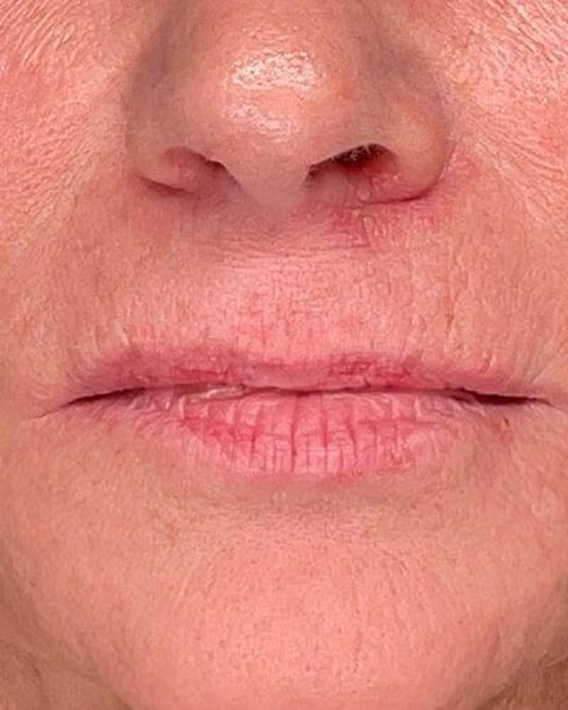 Dermal Fillers Before & After Gallery - Patient 365844 - Image 1