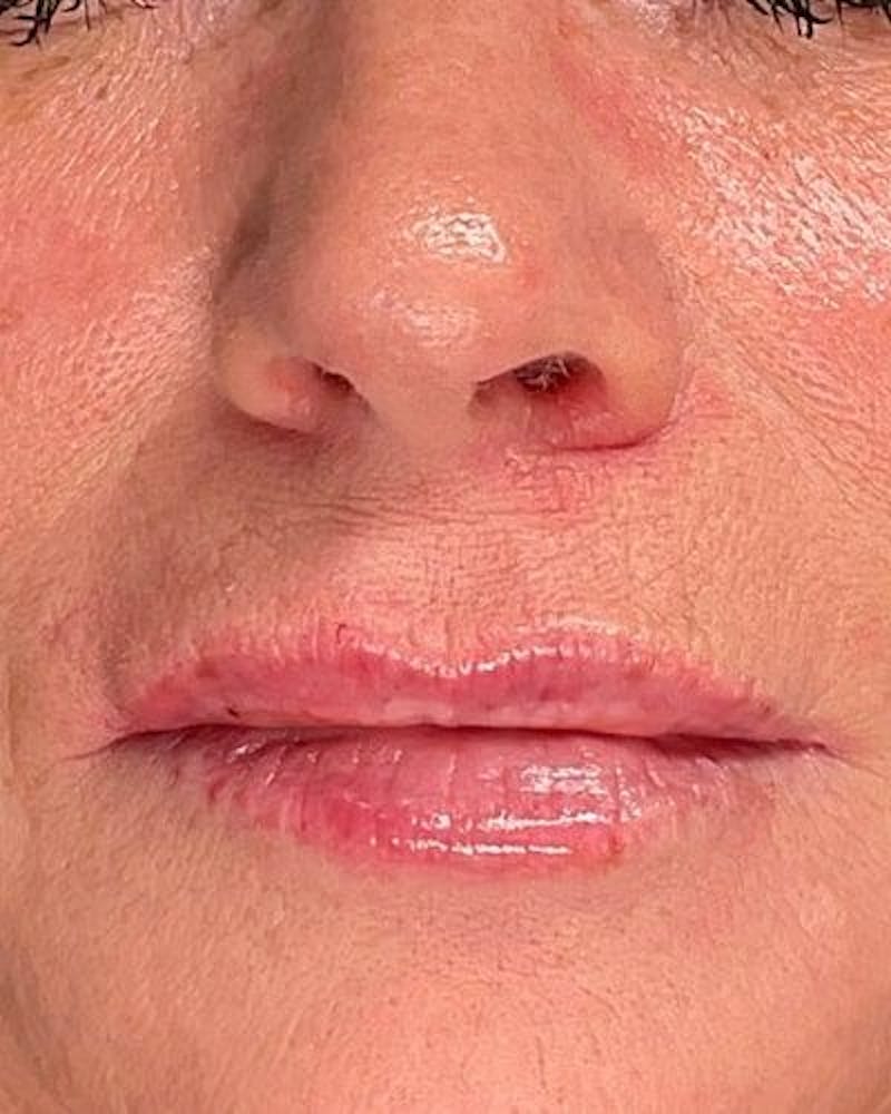 Dermal Fillers Before & After Gallery - Patient 365844 - Image 2