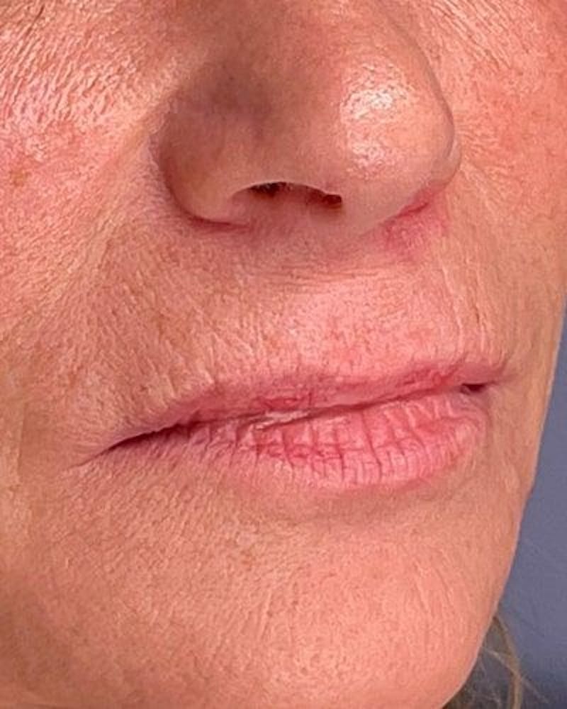 Dermal Fillers Before & After Gallery - Patient 365844 - Image 3
