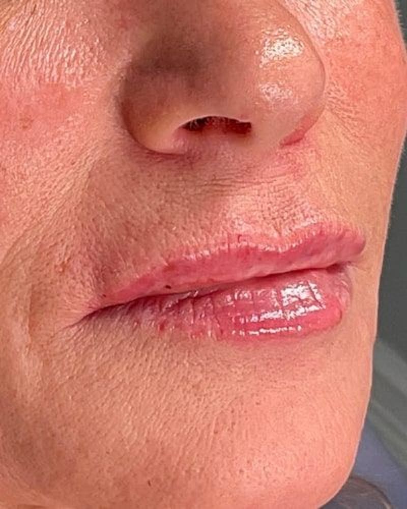 Dermal Fillers Before & After Gallery - Patient 365844 - Image 4