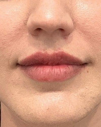 Dermal Fillers Before & After Gallery - Patient 254723 - Image 1
