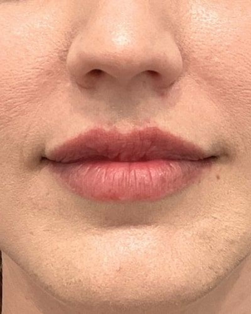 Dermal Fillers Before & After Gallery - Patient 254723 - Image 1